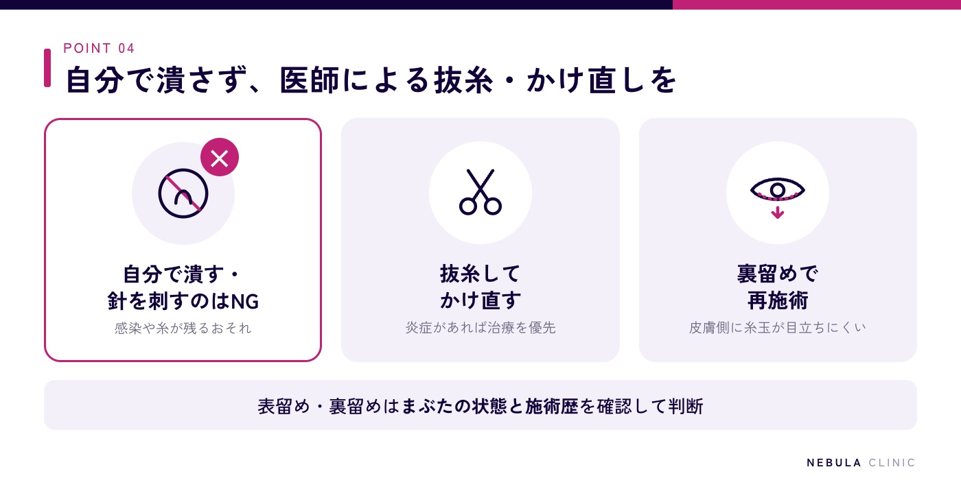 糸玉が気になるときの対処法の図解（自分で針を刺したり潰したりしない、クリニックで抜糸して適切な深さでかけ直す、まぶたの裏側で固定する裏留めでの再施術、表留め・裏留めはまぶたの状態と施術歴で判断）