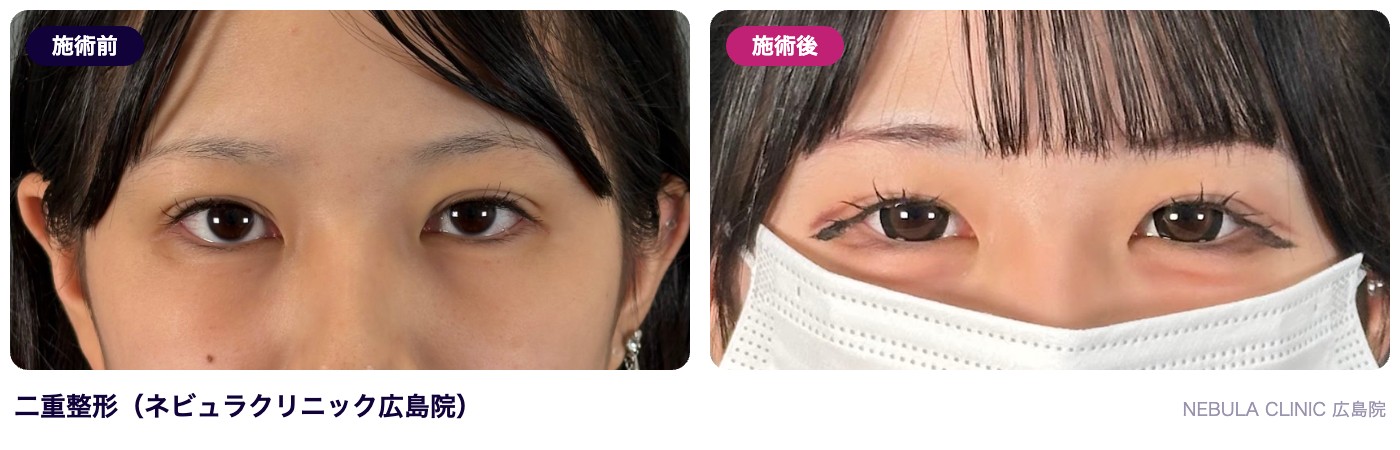 ネビュラクリニック広島院の二重整形の症例写真（施術前・施術後）
