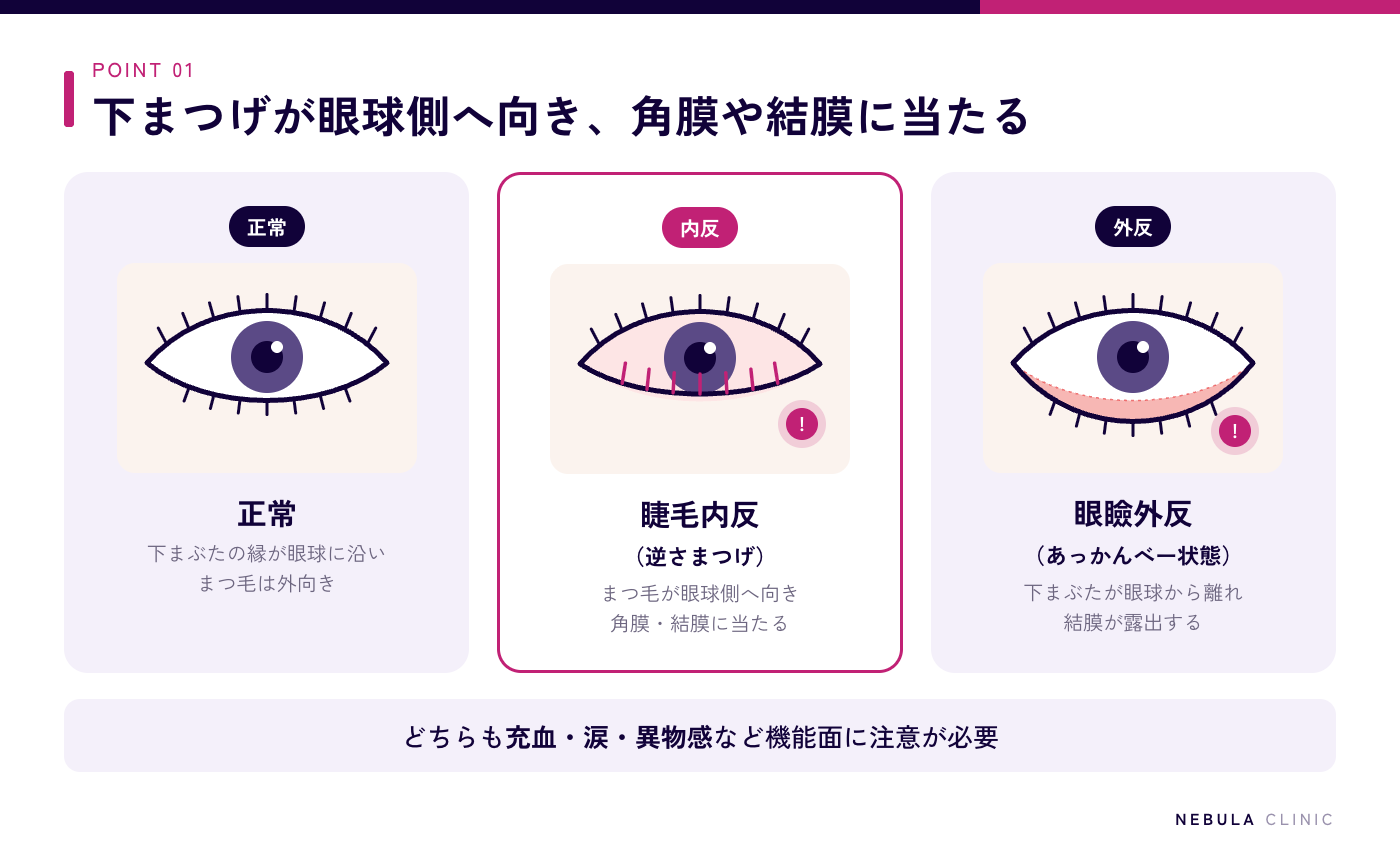 グラマラスライン形成後の逆さまつげの図解（下まぶたの縁が眼球に沿いまつ毛が外を向く正常な状態、下眼瞼縁が眼球側へ向き下まつげが角膜に当たる睫毛内反、下まぶたが眼球から離れてめくれる眼瞼外反を目元のイラストで比較）