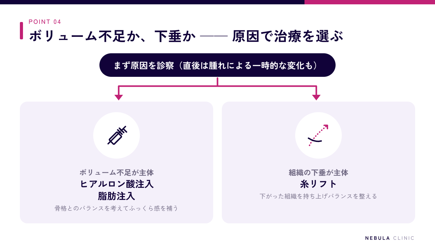 ハイフで頬がこけてしまった場合の修正方法の図解（まず原因を診察し、ボリューム不足が主体ならヒアルロン酸注入や脂肪注入でふっくら感を補い、下垂が主体なら糸リフトで組織を持ち上げる）