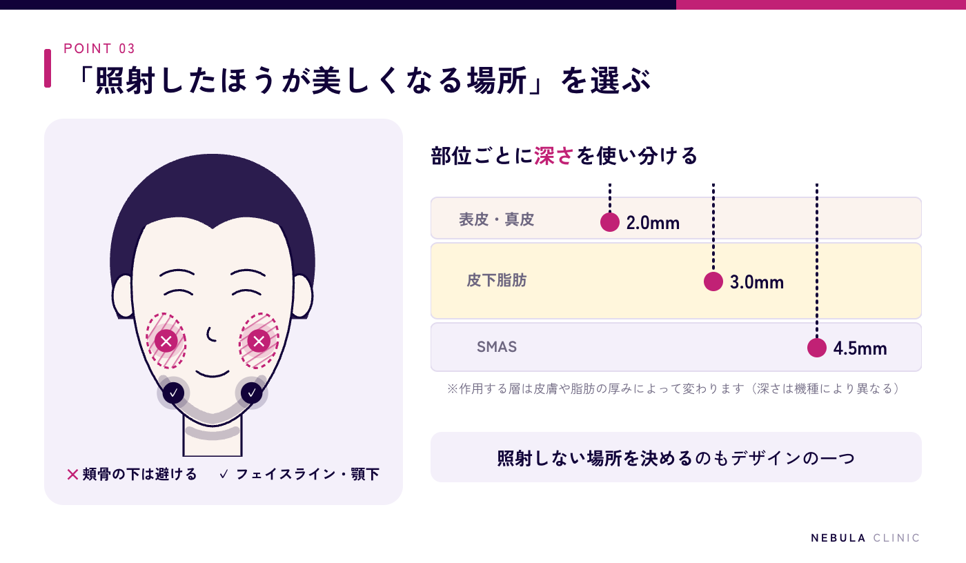 頬をこけさせないハイフの照射デザインの図解（正面顔で頬骨の下のくぼみエリアは照射を避け、フェイスライン・顎下を中心に照射。4.5mm・3.0mm・2.0mmなどカートリッジの深さを部位ごとの組織の厚さに合わせて使い分ける）