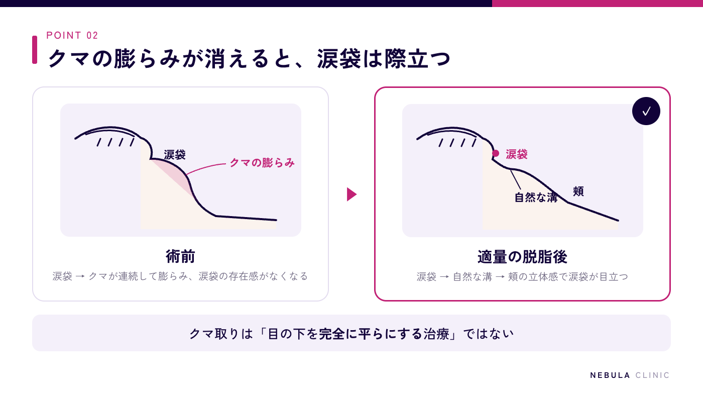 クマ取り前後の目の下の立体感の比較図解（術前は涙袋とクマの膨らみが連続して膨らみ涙袋が目立たない、適量の眼窩脂肪を除去すると涙袋・自然な溝・頬の立体感が生まれ涙袋が際立つ）