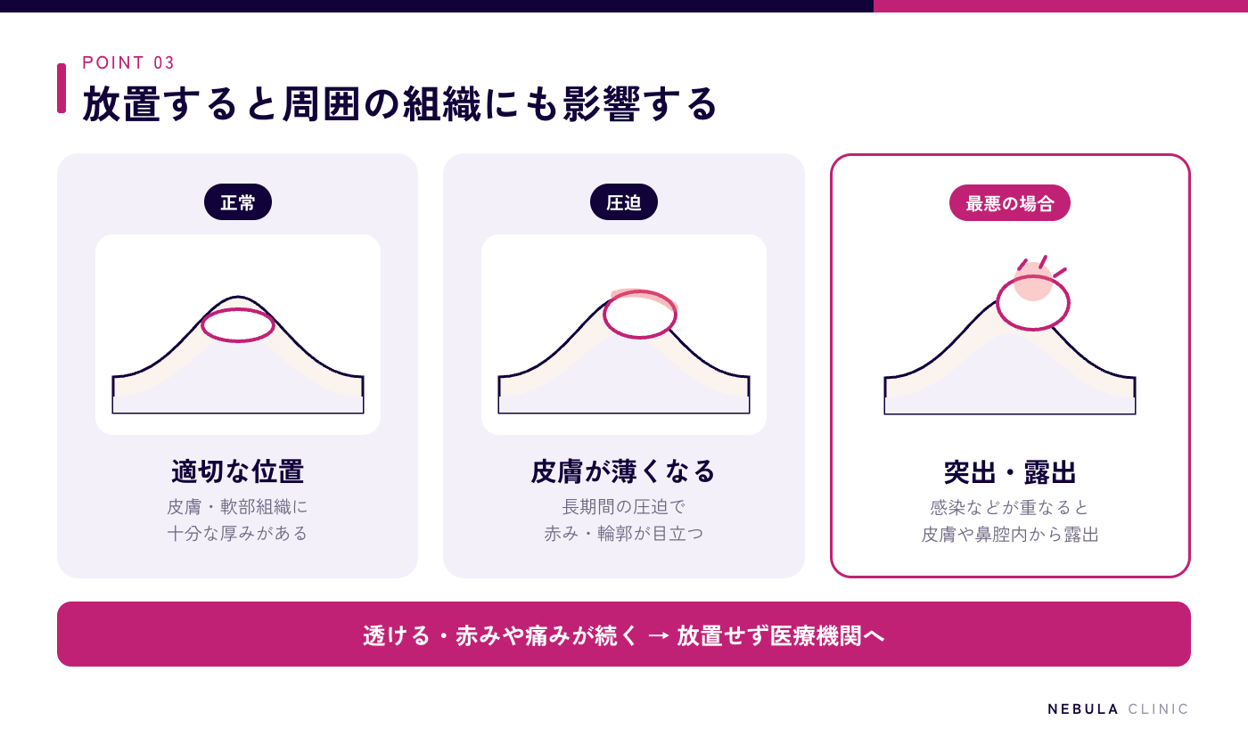 ズレたプロテーゼを放置するリスク（長期間の圧迫で皮膚が薄くなり赤みが出る、感染などが重なるとプロテーゼが皮膚や鼻腔内から突出・露出することもある）の図解