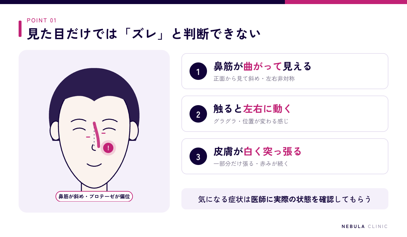 鼻プロテーゼのズレのサイン（正面から見て鼻筋が曲がる・左右非対称、触るとプロテーゼが左右に動く、鼻先や鼻筋の一部の皮膚が白く突っ張る）を顔のイラストで示した図解