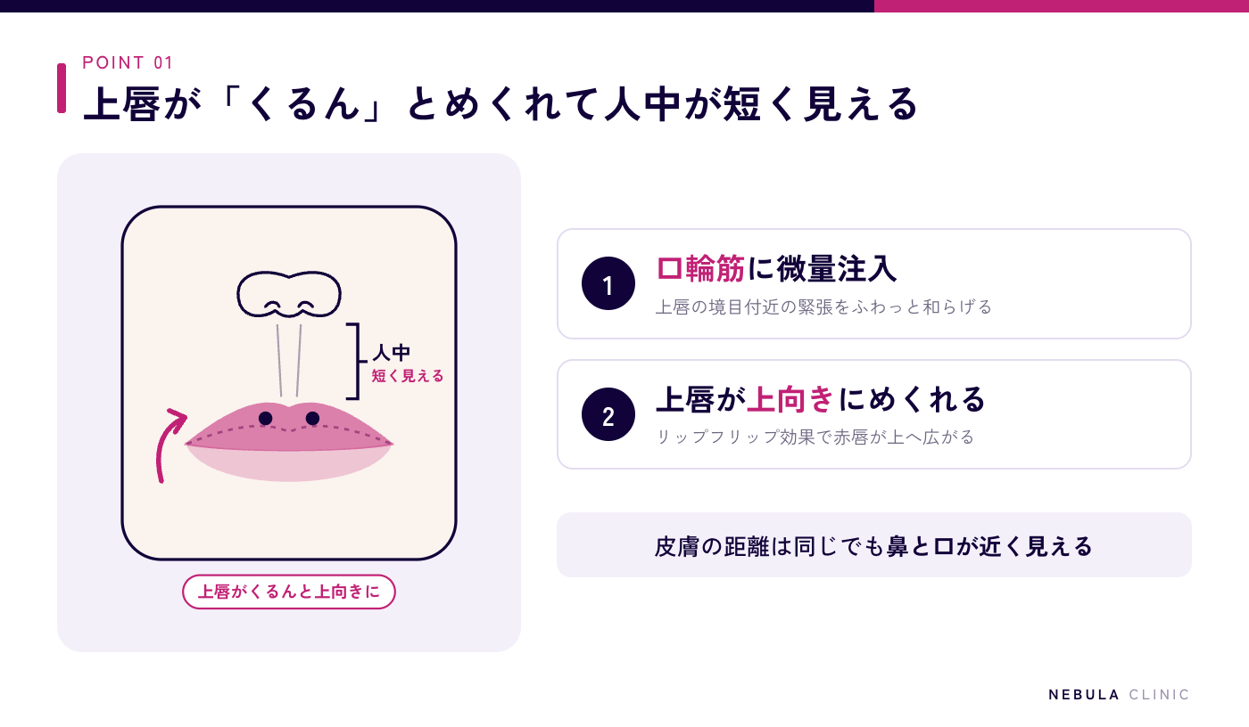 人中短縮ボトックス（リップフリップ）の仕組みの図解（上唇の口輪筋にボトックスを微量注入して緊張を和らげ、上唇が上向きにめくれることで、皮膚の距離は変わらなくても鼻と口の距離が短く見える）