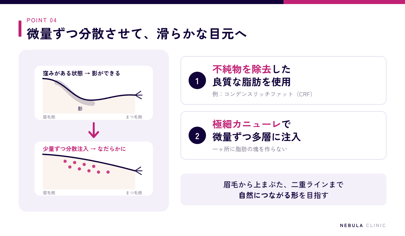 定着率を高め滑らかに仕上げる脂肪注入の技術(不純物を除去した良質な脂肪を使い、極細カニューレで微量ずつ多層に分散注入することで、窪んで影ができた上まぶたをなだらかなラインに整える)の断面イメージ図解